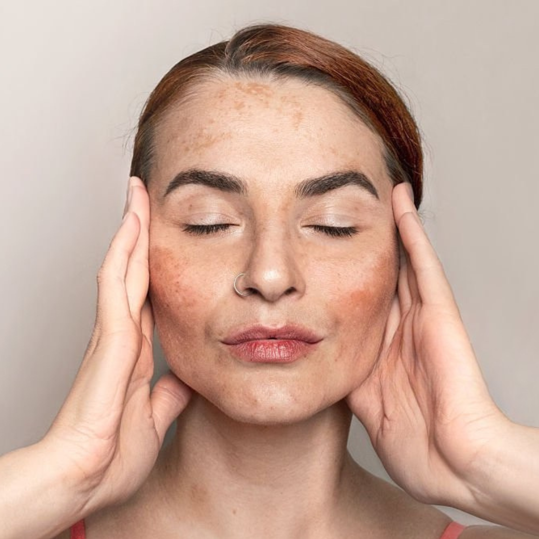 Pigmentation
