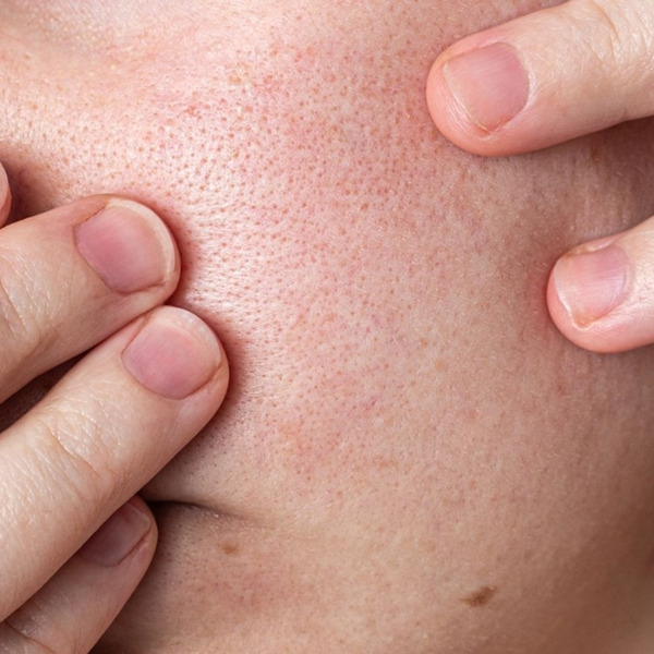 Pores dilatés